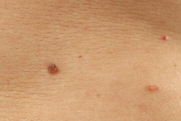 Man with moles on his skin, closeup