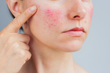 Young Caucasian woman suffering from rosacea on her face in the acute stage, she showing redness on...