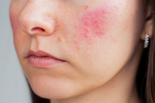 Young Caucasian woman suffering from rosacea on her face in the acute stage. Dermatological problems. Skin chronic disease