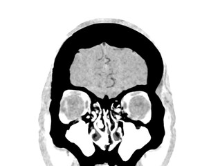 CTA Brain Vascular Imaging , highlights a detailed 3D CTA scan of the brain’s vascular network, showing clear visualization of arteries and blood flow for diagnostic purposes.