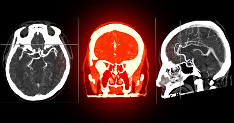 CTA Brain Vascular Imaging , highlights a detailed 3D CTA scan of the brain’s vascular network, showing clear visualization of arteries and blood flow for diagnostic purposes.