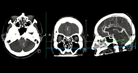 CTA Brain Vascular Imaging , highlights a detailed 3D CTA scan of the brain’s vascular network, showing clear visualization of arteries and blood flow for diagnostic purposes.