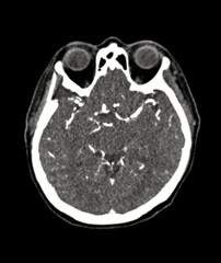 A clear, black-and-white CT scan showing the normal structure of the brain, highlighting the distinct borders and absence of abnormalities.
