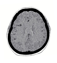 A clear, black-and-white CT scan showing the normal structure of the brain, highlighting the distinct borders and absence of abnormalities.