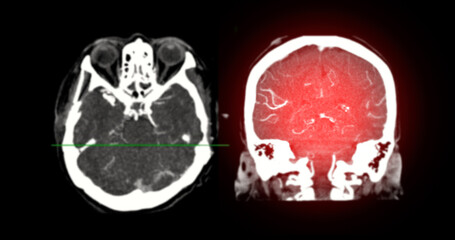 CTA Brain Vascular Imaging , highlights a detailed 3D CTA scan of the brain’s vascular network, showing clear visualization of arteries and blood flow for diagnostic purposes.