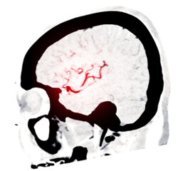 CTA Brain Vascular Imaging , highlights a detailed 3D CTA scan of the brain’s vascular network, showing clear visualization of arteries and blood flow for diagnostic purposes.