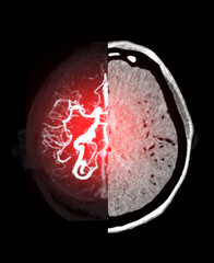 A dual-perspective view of the brain, showcasing the blood vessels in vibrant red on one side and a grayscale CT scan on the other, symbolizing the blend of vitality and medical imaging.