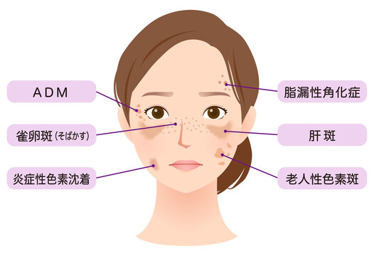 シミができた女性の顔　美容　名称