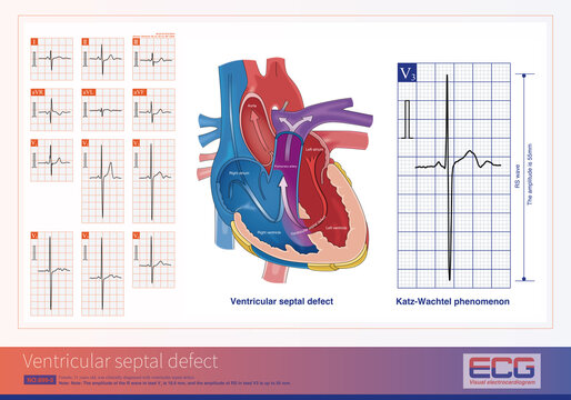 In ventricular septal defects, left ventricular hypertrophy, biventricular hypertrophy, or right ventricular hypertrophy ECG may be present.
