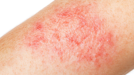 Fototapeta premium Skin rash: close-up image reveals inflammation and redness indicative of a skin condition. Healthcare, dermatology, and well-being implications.