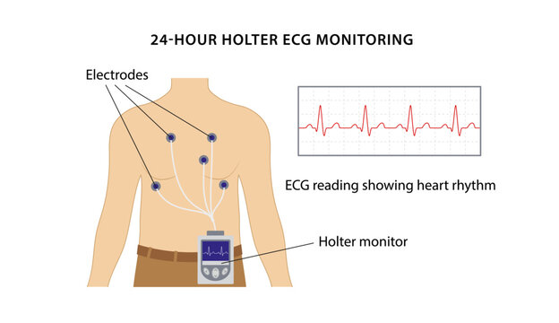 24-hour Holter ECG monitoring. Electrocardiogram. Heart cardiogram. ECG reading showing heart rhythm. Vector illustration in flat style isolated on white background