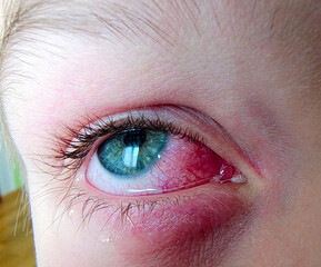 Close-up of irritated blue eye with redness and swelling. Eye infection or allergic reaction....