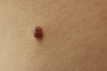 Man with mole on his skin, closeup