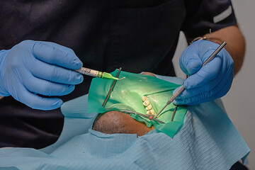 Close-up view of a dental treatment with a rubber dam in place. Multiple tools and gloved hands...