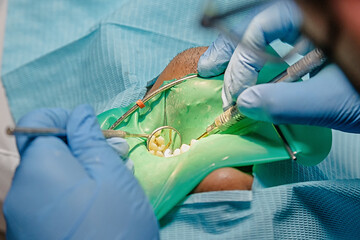 Close-up view of a dental treatment with a rubber dam in place. Multiple tools and gloved hands...