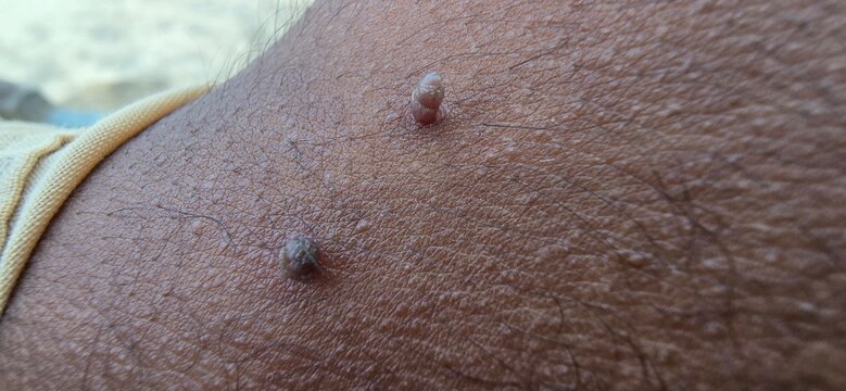 Skin Tags on the different body parts