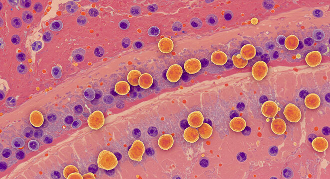 Cryptosporidium oocysts on intestinal epithelium, acid-fast stain