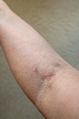 Close-up of a human forearm showing bruising and discoloration at the site of a recent blood draw.