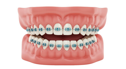 Obraz premium Isolated Dental Model with Braces