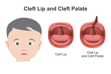 Cleft lip and cleft palate illustration
