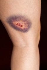 Wound and bruise on human leg after dog bite