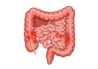 Illustration of Human Intestine Colon Disease Digestive Organ Anatomy