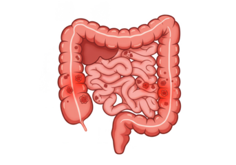 Illustration of Human Intestine Colon Disease Digestive Organ Anatomy