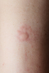 Ringworm showing on human skin causing redness and irritation