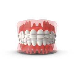 Dental Model with Orthodontic Braces Isolated on Transparent Background