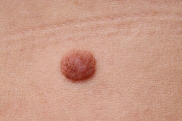 Woman with mole on her body, closeup