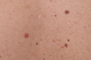 Fototapeta premium Woman with moles on her body, closeup