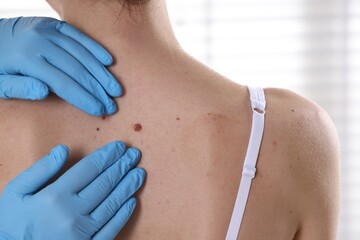 Doctor examining woman's moles in hospital, closeup