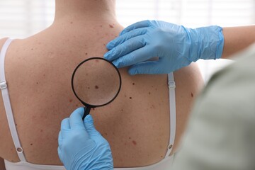 Doctor examining woman's moles in hospital, closeup