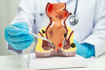 Asian doctor with rectum and hemorrhoid human anatomy model at hospital, inflamed vascular...