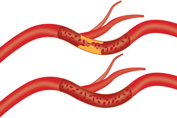 Medical diagram of artery blockage versus normal blood vessel for health education