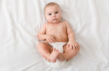 Measles. Upset newborn baby suffering from viral disease rash, lying on bed, top view