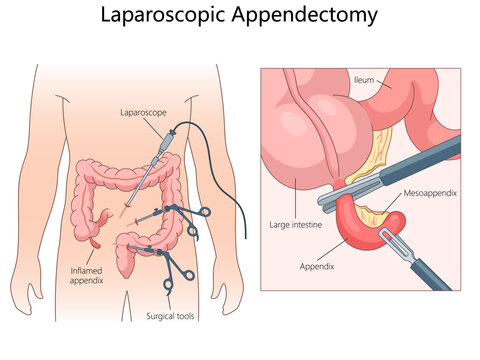 Laparoscopic appendectomy, instruments used and the removal of an inflamed appendix from the large intestine diagram hand drawn schematic vector illustration. Medical science educational illustration