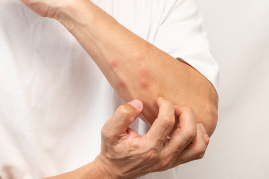 虫に刺された男性の腕