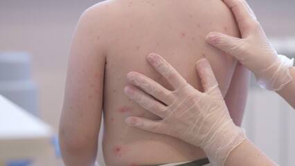 A child with a skin condition chickenpox is found enjoying themselves in a casual and playful environment