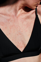 Close-up of woman skin affected by psoriasis. Eczema, rash and other skin diseases. Autoimmune...