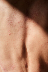 Close-up of skin affected by psoriasis. Eczema, rash and other skin diseases. Autoimmune genetic disease. Imperfect beauty.