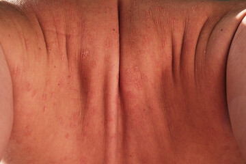 Close-up of skin affected by psoriasis. Eczema, rash and other skin diseases. Autoimmune genetic disease. Imperfect beauty.