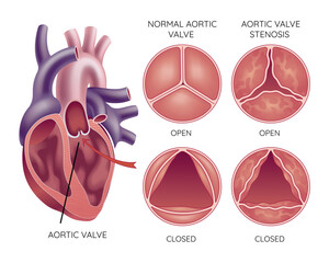 Medical illustration shows the difference between a normal aortic valve and one with stenosis, open and closed, and its location in the heart, with annotations