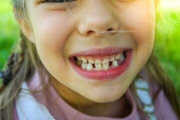 The smile of a cute girl. Three teeth have fallen out, there is little space for molars. Milk teeth fall out. Close-up. 