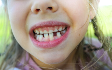 The smile of a cute girl. Three teeth have fallen out, there is little space for molars. Milk teeth fall out. Close-up. 