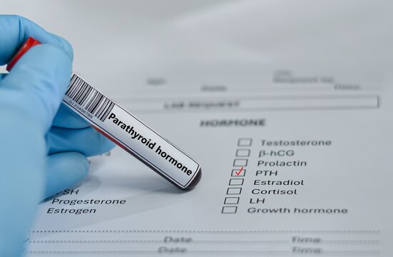 Blood sample tube for parathyroid hormone (PTH) test analysis.
