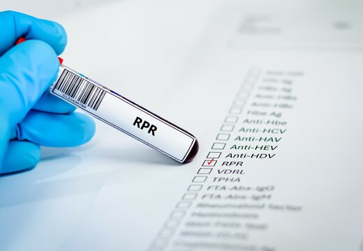 Blood sample tube for RPR test analysis.