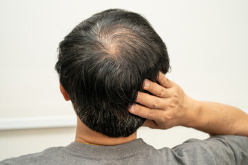 Fototapeta premium Bald in the middle head and begin no loss hair glabrous of mature Asian business smart active office man.