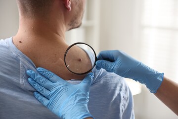 Doctor examining man's moles in hospital, closeup