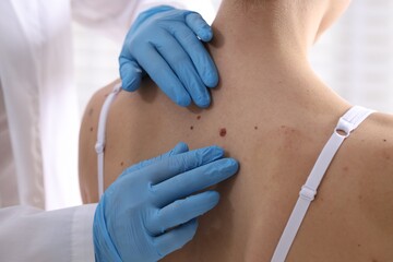 Doctor examining woman's moles in hospital, closeup